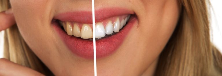 Katy Texas Teeth Whitening